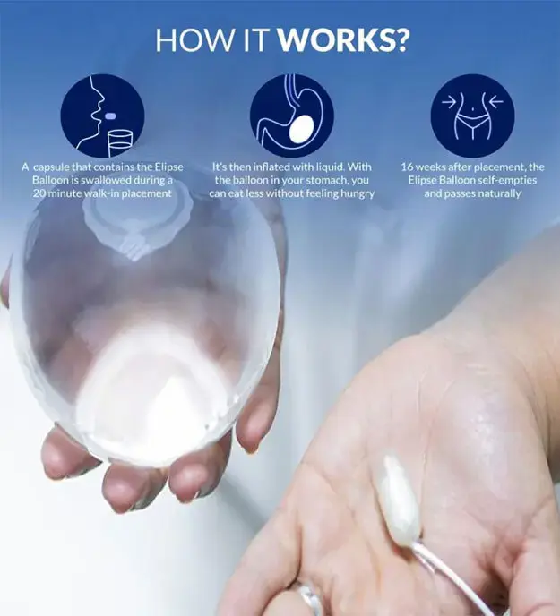 Gastric Balloon Surgery Melbourne