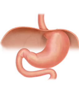 Hiatal Hernia & Anti Reflux Surgery