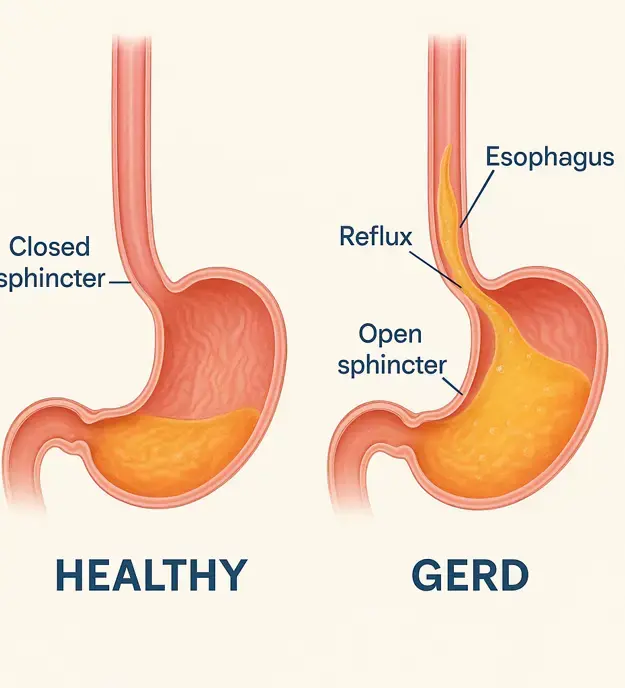 Anti Reflux Surgery Melbourne