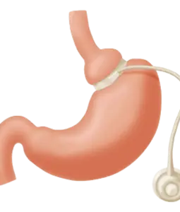 Gastric Band Surgery Melbourne
