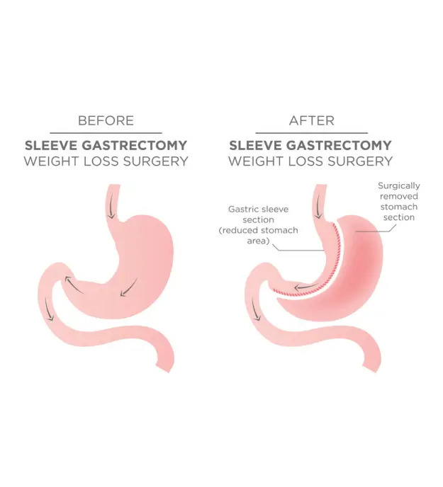 Vertical Sleeve Gastrectomy Melbourne