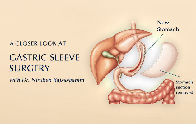A Closer Look at Gastric Sleeve Surgery with Dr. Niruben Rajasagaram (1)