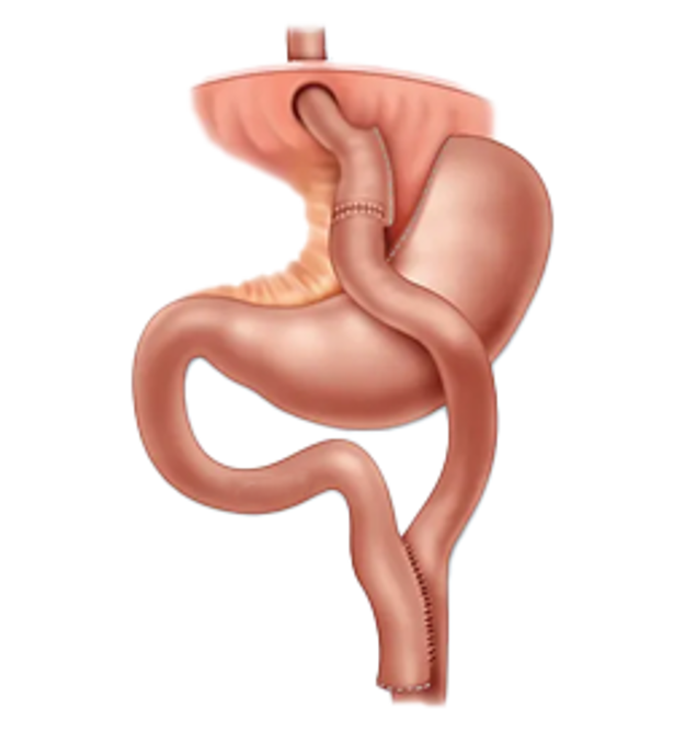 Roux en-y Gastric Bypass