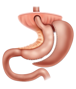 Laparoscopic Sleeve Gastrectomy