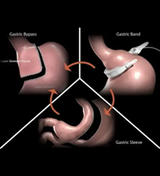 Revisional Bariatric Surgery