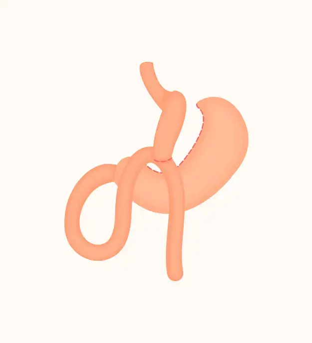 Mini Gastric Bypass Surgery Melbourne