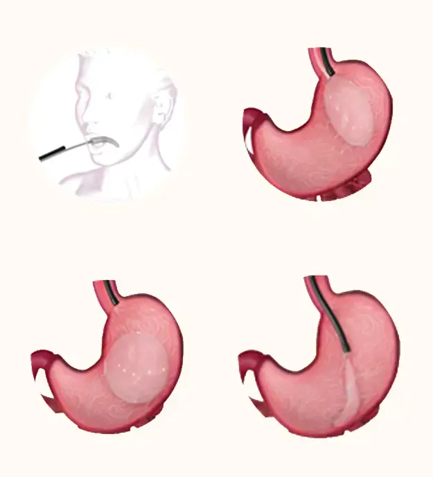 Gastric Balloon Surgery