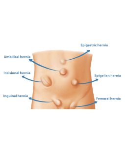 Hernia Surgery