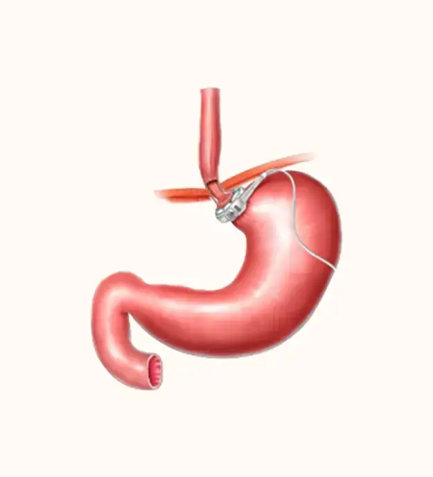 Gastric Band Surgery