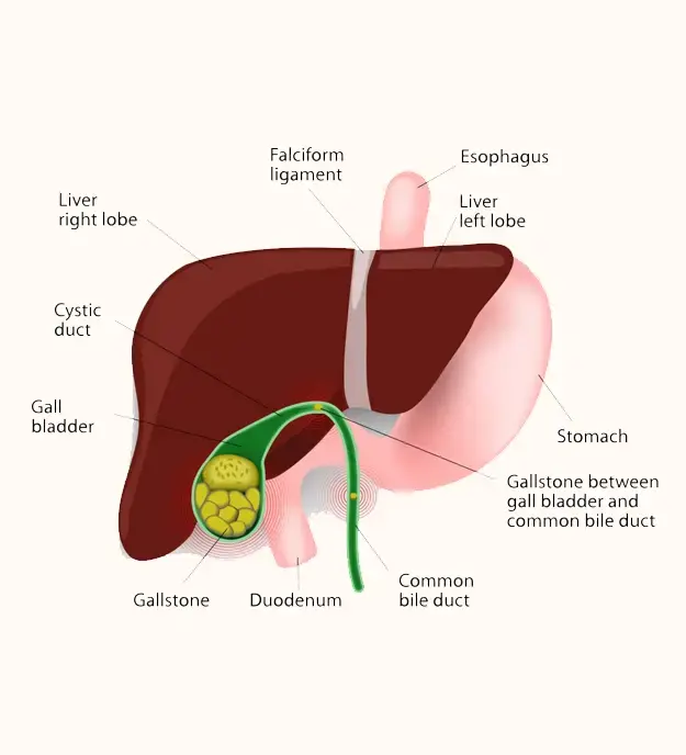 Gallbladder Surgery In Melbourne